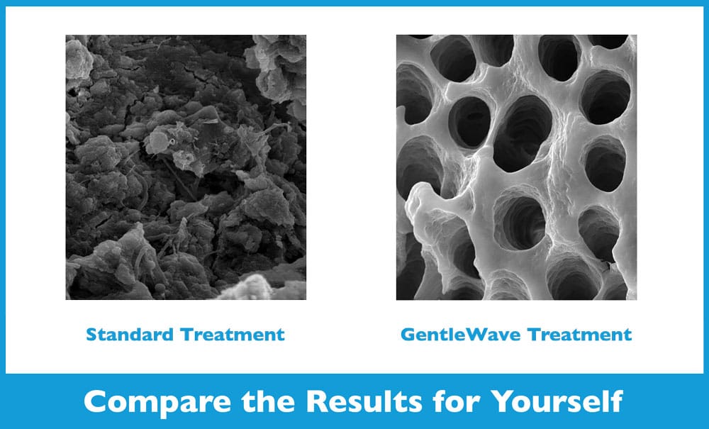 Standard Root Canal vs GentleWave Procedure in Solon, OH