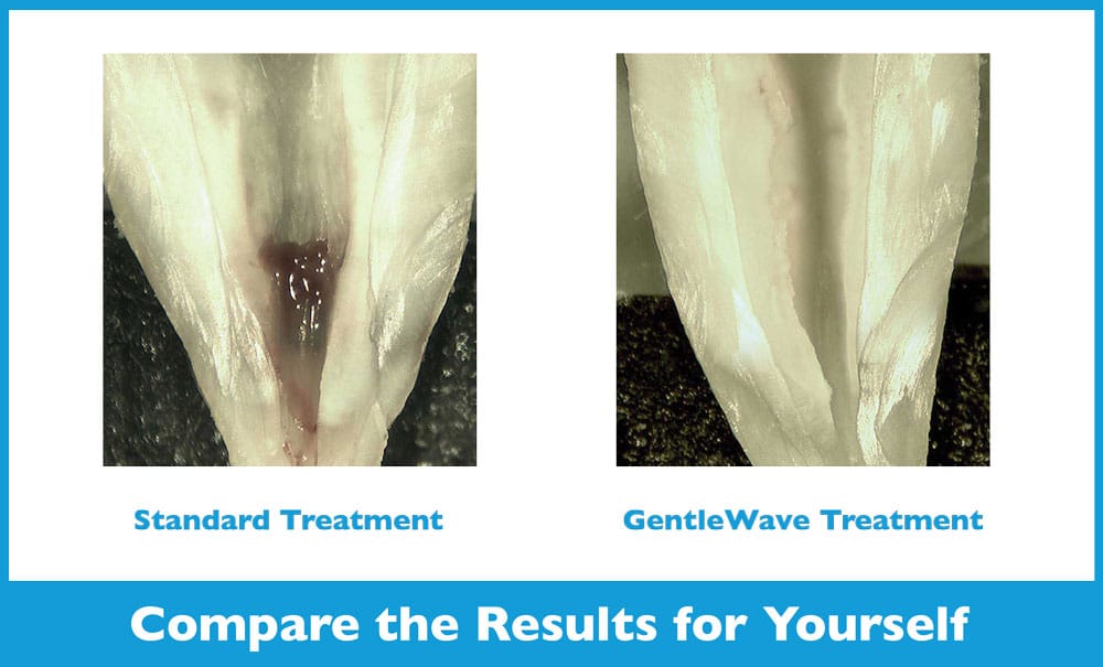 Standard Root Canal vs GentleWave Procedure in Solon, OH