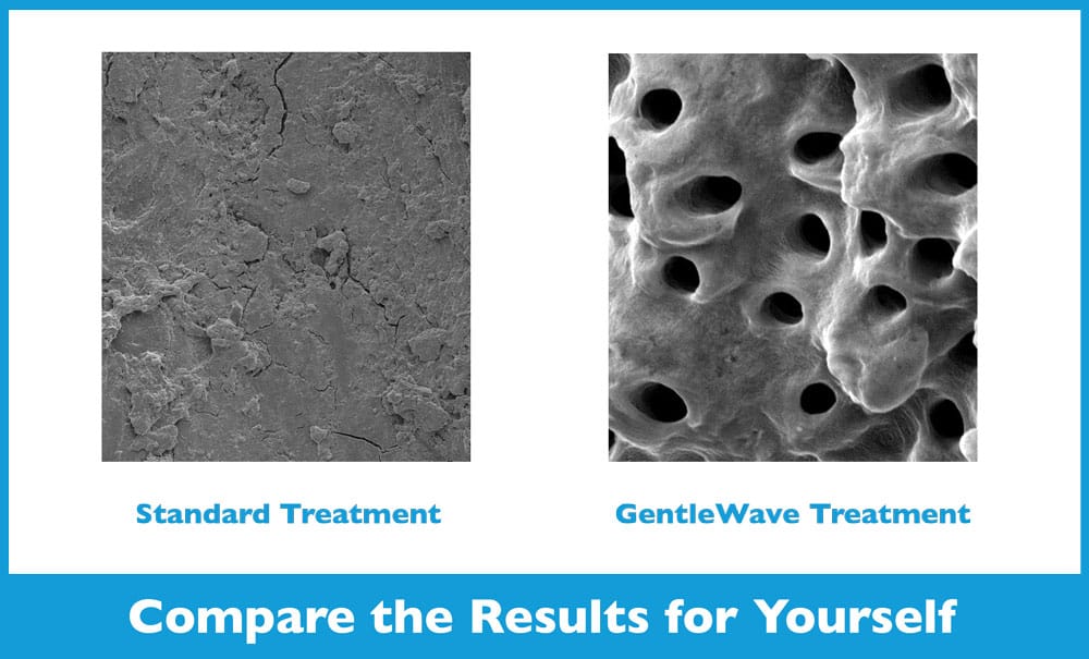 Standard Root Canal vs GentleWave Procedure in Solon, OH