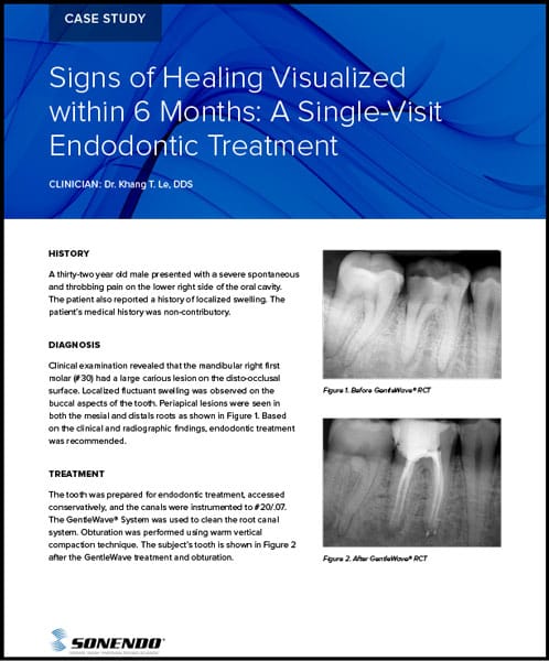 Signs of Healing Visualized within 6 Months: A Single-Visit Endodontic Treatment in Solon, OH